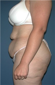 Tummy Tuck Before Photo by Karol Gutowski, MD, FACS; Glenview, IL - Case 39109