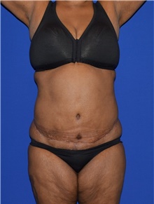 Tummy Tuck After Photo by Karol Gutowski, MD, FACS; Glenview, IL - Case 39110