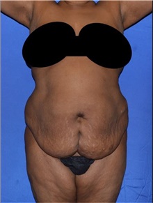 Tummy Tuck Before Photo by Karol Gutowski, MD, FACS; Glenview, IL - Case 39110