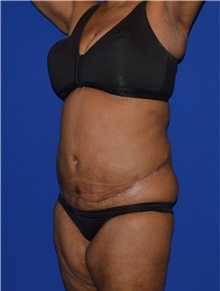 Tummy Tuck After Photo by Karol Gutowski, MD, FACS; Glenview, IL - Case 39110