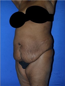 Tummy Tuck Before Photo by Karol Gutowski, MD, FACS; Glenview, IL - Case 39110