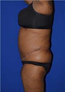 Tummy Tuck After Photo by Karol Gutowski, MD, FACS; Glenview, IL - Case 39110