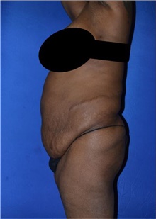 Tummy Tuck Before Photo by Karol Gutowski, MD, FACS; Glenview, IL - Case 39110