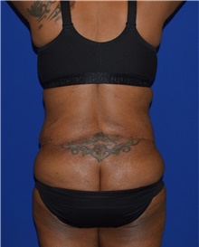 Tummy Tuck After Photo by Karol Gutowski, MD, FACS; Glenview, IL - Case 39110