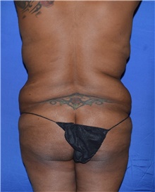 Tummy Tuck Before Photo by Karol Gutowski, MD, FACS; Glenview, IL - Case 39110