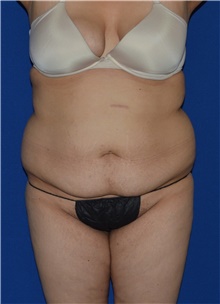 Tummy Tuck Before Photo by Karol Gutowski, MD, FACS; Glenview, IL - Case 39111