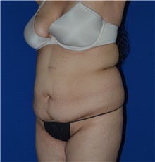 Tummy Tuck Before Photo by Karol Gutowski, MD, FACS; Glenview, IL - Case 39111