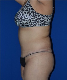 Tummy Tuck After Photo by Karol Gutowski, MD, FACS; Glenview, IL - Case 39111