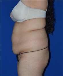 Tummy Tuck Before Photo by Karol Gutowski, MD, FACS; Glenview, IL - Case 39111