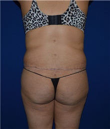 Tummy Tuck After Photo by Karol Gutowski, MD, FACS; Glenview, IL - Case 39111