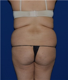 Tummy Tuck Before Photo by Karol Gutowski, MD, FACS; Glenview, IL - Case 39111