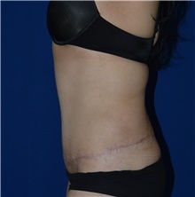 Tummy Tuck After Photo by Karol Gutowski, MD, FACS; Glenview, IL - Case 39113