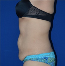 Tummy Tuck Before Photo by Karol Gutowski, MD, FACS; Glenview, IL - Case 39113