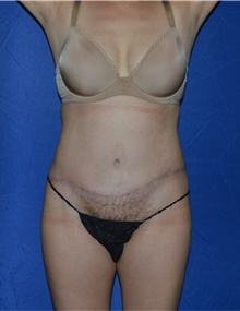 Tummy Tuck After Photo by Karol Gutowski, MD, FACS; Glenview, IL - Case 39114