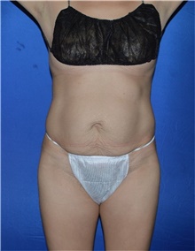 Tummy Tuck Before Photo by Karol Gutowski, MD, FACS; Glenview, IL - Case 39114