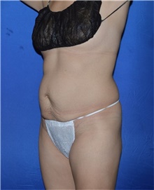 Tummy Tuck Before Photo by Karol Gutowski, MD, FACS; Glenview, IL - Case 39114