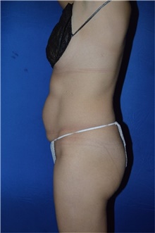 Tummy Tuck Before Photo by Karol Gutowski, MD, FACS; Glenview, IL - Case 39114