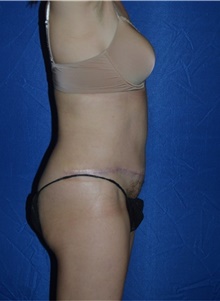 Tummy Tuck After Photo by Karol Gutowski, MD, FACS; Glenview, IL - Case 39114