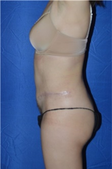 Tummy Tuck After Photo by Karol Gutowski, MD, FACS; Glenview, IL - Case 39116