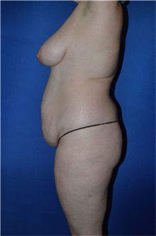 Tummy Tuck Before Photo by Karol Gutowski, MD, FACS; Glenview, IL - Case 39116