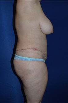 Tummy Tuck After Photo by Karol Gutowski, MD, FACS; Glenview, IL - Case 39116