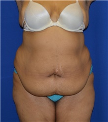 Tummy Tuck Before Photo by Karol Gutowski, MD, FACS; Glenview, IL - Case 39117