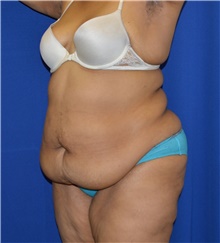 Tummy Tuck Before Photo by Karol Gutowski, MD, FACS; Glenview, IL - Case 39117