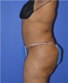 Tummy Tuck After Photo by Karol Gutowski, MD, FACS; Glenview, IL - Case 39117