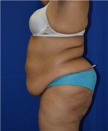 Tummy Tuck Before Photo by Karol Gutowski, MD, FACS; Glenview, IL - Case 39117