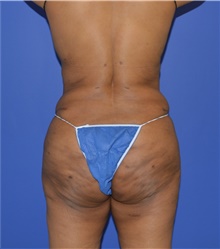 Tummy Tuck After Photo by Karol Gutowski, MD, FACS; Glenview, IL - Case 39117