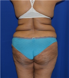 Tummy Tuck Before Photo by Karol Gutowski, MD, FACS; Glenview, IL - Case 39117