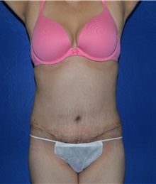 Tummy Tuck After Photo by Karol Gutowski, MD, FACS; Glenview, IL - Case 39118