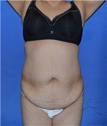 Tummy Tuck Before Photo by Karol Gutowski, MD, FACS; Glenview, IL - Case 39118