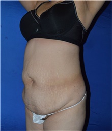 Tummy Tuck Before Photo by Karol Gutowski, MD, FACS; Glenview, IL - Case 39118