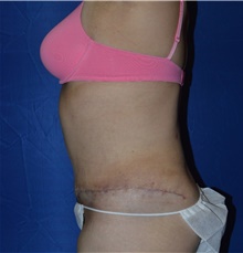 Tummy Tuck After Photo by Karol Gutowski, MD, FACS; Glenview, IL - Case 39118