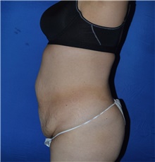 Tummy Tuck Before Photo by Karol Gutowski, MD, FACS; Glenview, IL - Case 39118