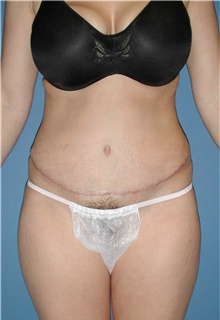 Tummy Tuck After Photo by Karol Gutowski, MD, FACS; Glenview, IL - Case 39119