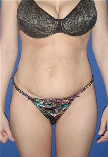 Tummy Tuck Before Photo by Karol Gutowski, MD, FACS; Glenview, IL - Case 39119