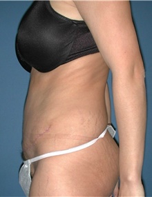 Tummy Tuck After Photo by Karol Gutowski, MD, FACS; Glenview, IL - Case 39119