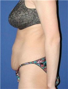 Tummy Tuck Before Photo by Karol Gutowski, MD, FACS; Glenview, IL - Case 39119