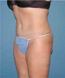 Tummy Tuck After Photo by Karol Gutowski, MD, FACS; Glenview, IL - Case 39120