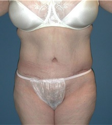 Tummy Tuck After Photo by Karol Gutowski, MD, FACS; Glenview, IL - Case 39122