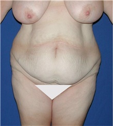 Tummy Tuck Before Photo by Karol Gutowski, MD, FACS; Glenview, IL - Case 39122