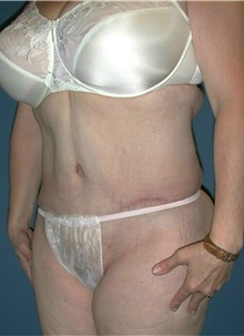 Tummy Tuck After Photo by Karol Gutowski, MD, FACS; Glenview, IL - Case 39122