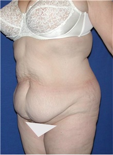 Tummy Tuck Before Photo by Karol Gutowski, MD, FACS; Glenview, IL - Case 39122