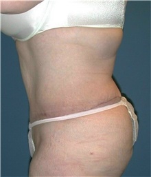 Tummy Tuck After Photo by Karol Gutowski, MD, FACS; Glenview, IL - Case 39122