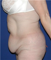 Tummy Tuck Before Photo by Karol Gutowski, MD, FACS; Glenview, IL - Case 39122