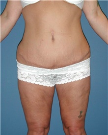 Tummy Tuck After Photo by Karol Gutowski, MD, FACS; Glenview, IL - Case 39123