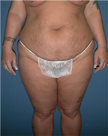 Tummy Tuck Before Photo by Karol Gutowski, MD, FACS; Glenview, IL - Case 39123