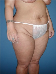 Tummy Tuck Before Photo by Karol Gutowski, MD, FACS; Glenview, IL - Case 39123